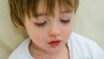 مرض الجدري أعراضه وأسبابه وطرق الوقاية