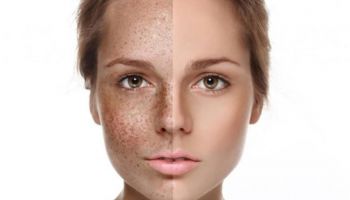 طرق طبيعية لعلاج الكلف والنمش